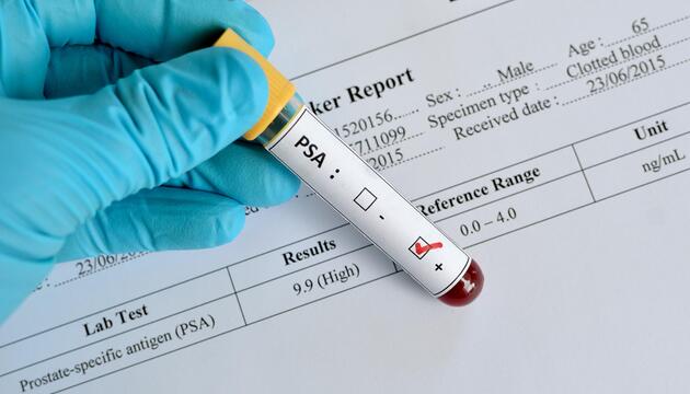 Prostata-Krebs, Welt-Krebstag, Früherkennung, Krebs