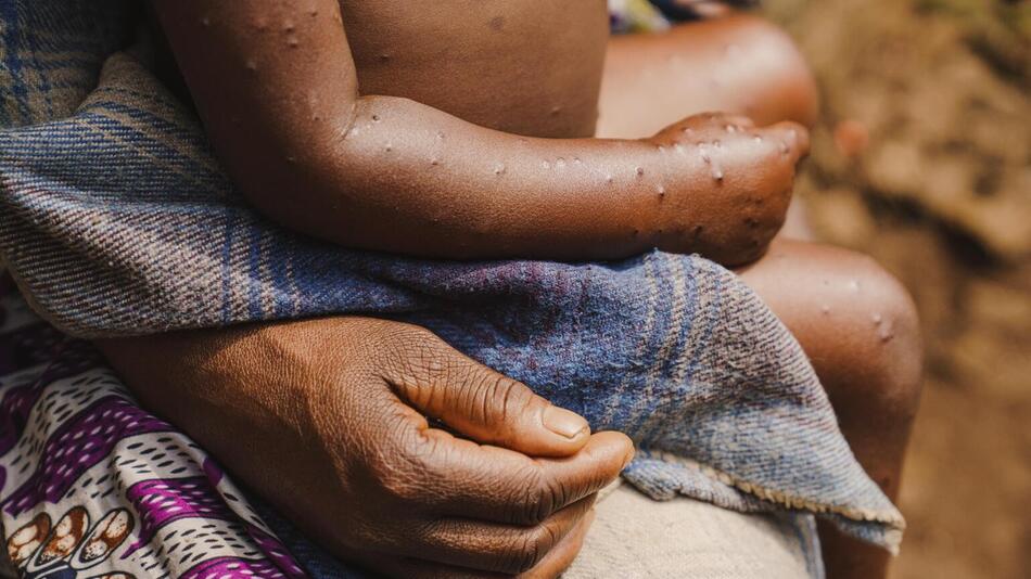 Ein Kleinkind mit Mpox-Virus in der Demokratischen Republik Kongo.