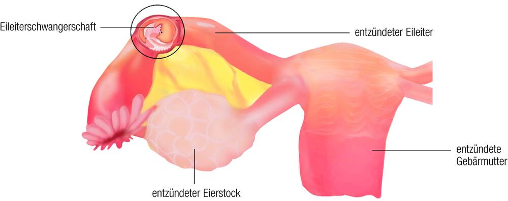 Grafik zu Eileiterschwangerschaft