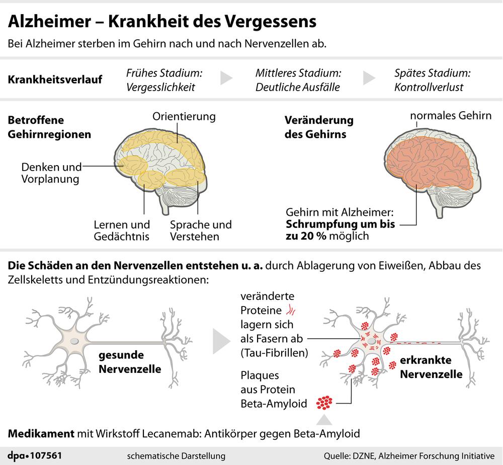 Grafik: "Das passiert bei Alzheimer im Gehirn; Angriffspunkt des Antikörpers des Medikaments"