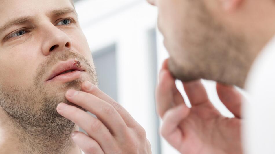 Herpes - warum bekommen es manche, andere nicht? 