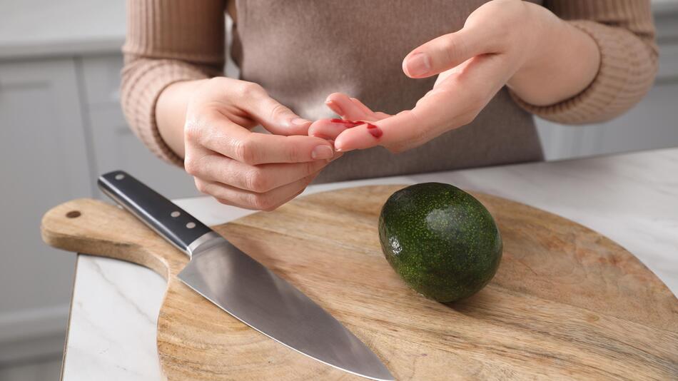 Verletzungen häufen sich bei jungen Frauen: Was ist die "Avocado-Hand"?